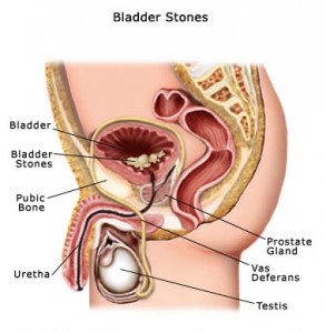 mens health bladder stones