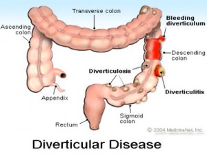 diverticular men's health