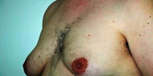 gynecomastia